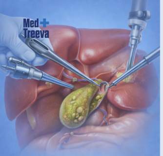 Gallbladder Stone Surgery in India