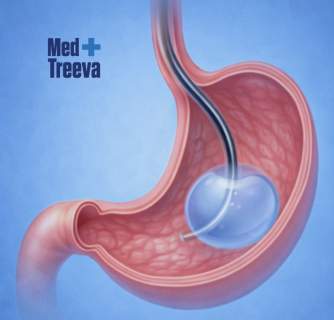 Gastric Balloon Surgery in India