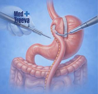 Gastric Bypass Surgery in India