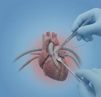 Heart Bypass Surgery in India