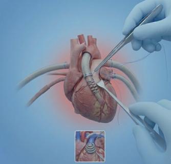 Heart Valve Surgery in India