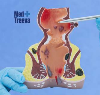 Hemorrhoid Surgery in India