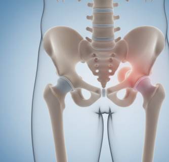 Hip Dysplasia Treatment in India