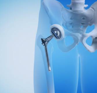 Hip Replacement in India