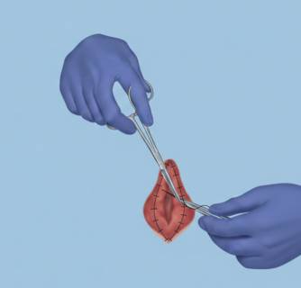 Hymenoplasty in India