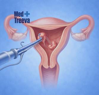 Hysteroscopic Polypectomy in India
