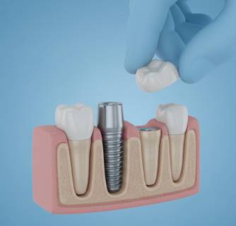 Immediate Dental Implants in India