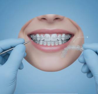 Invisible Braces Orthodontist in India