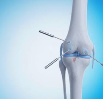 Knee Keyhole Surgery in India