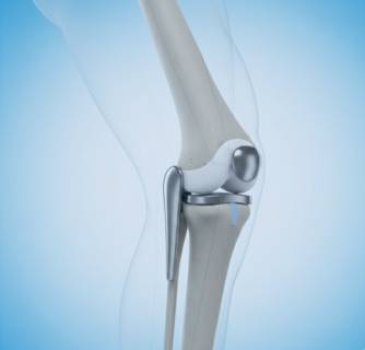 Knee Replacement Surgery in India