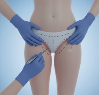 Labiaplasty Surgery in India