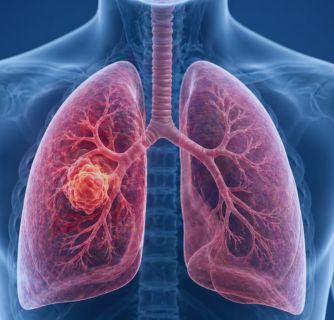 Lung Cancer Treatment in India