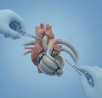 LVAD – Artificial Heart Surgery in India