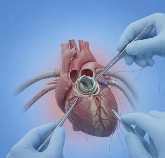 Mitral Valve Surgery in India