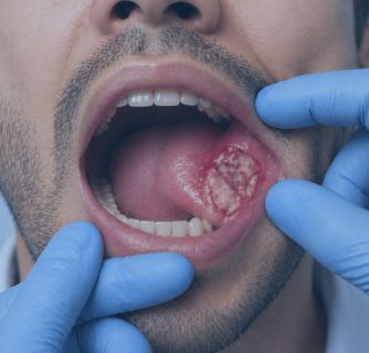 Oral Cancer Treatment in India