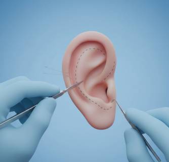 Otoplasty in India