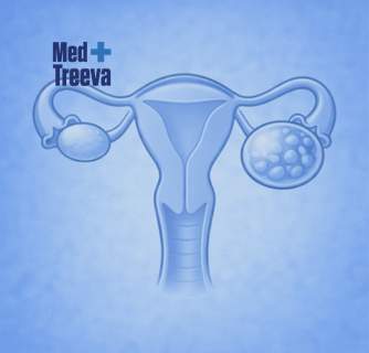 Ovarian Cyst Removal Surgery in India