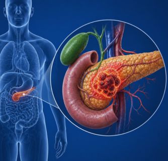 Pancreatic Cancer Treatment in India