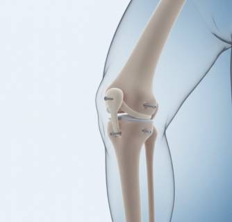 PCL Reconstruction Surgery in India