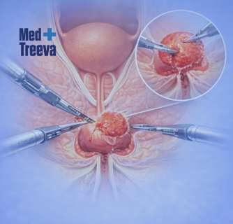 Radical Prostatectomy in India