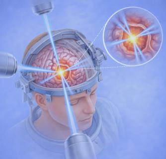 Stereotactic Radiosurgery in India