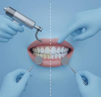 Teeth Whitening in India