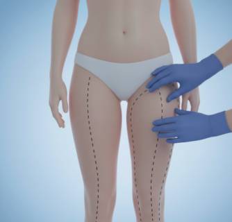 Thigh lift surgery in India