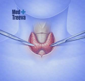 Thyroid Surgery in India