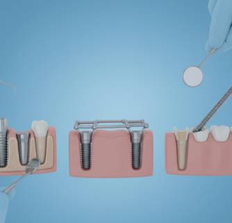Types of Dental Implants in India