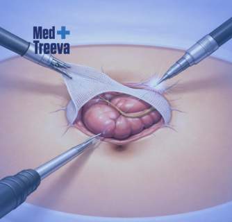 Umbilical Hernia Surgery in India