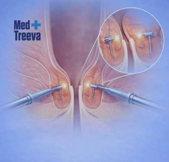 UroLift Surgery in India