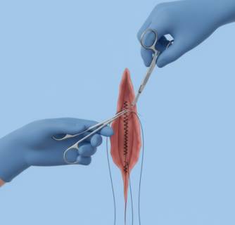Vaginoplasty in India