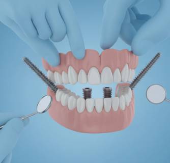 Zygomatic Implant in India